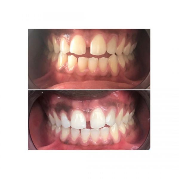 Whitening Toothpaste with Activated Charcoal