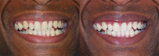 Whitening Toothpaste with Activated Charcoal